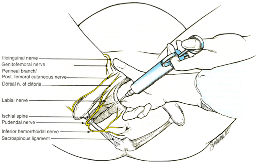 anesthesia diagram obgyn