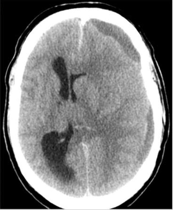 CT image of brain death