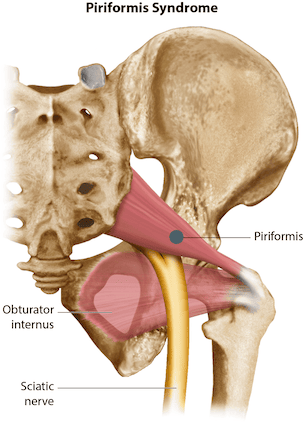 diagram of the piriformis syndrome from a COMLEX Level 1 sample question