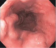 an endoscopic view of esophageal varices