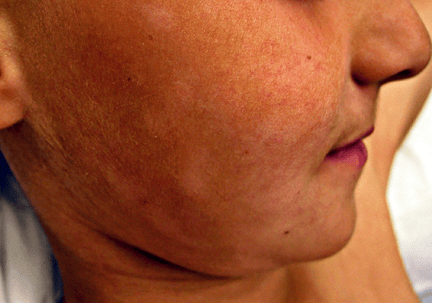 child's face with multiple asymptomatic macules and patches