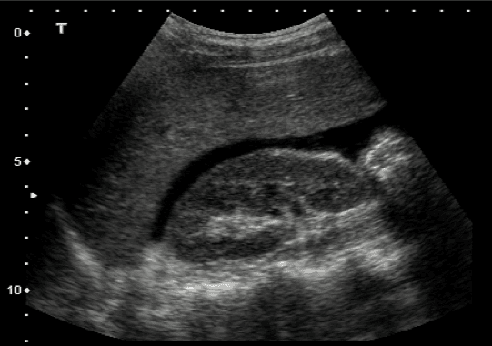 ultrasound of an abdomen from an ABEM ITE sample question