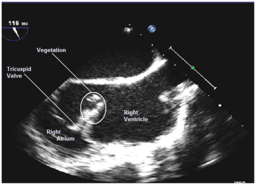 transesophageal echocardiogram of a patient with tricuspid valve