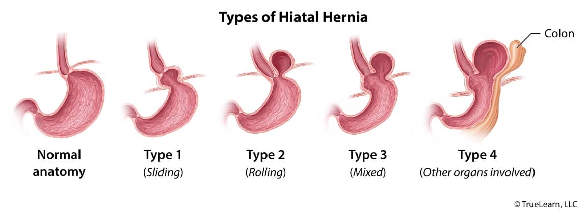 types of hiatal hernia diagram