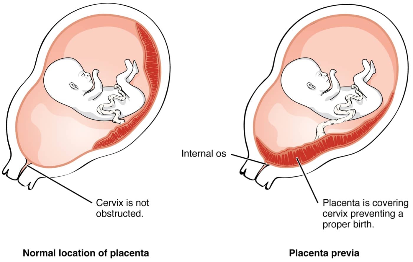 digram showing differences between a normal placenta location vs a placenta previa