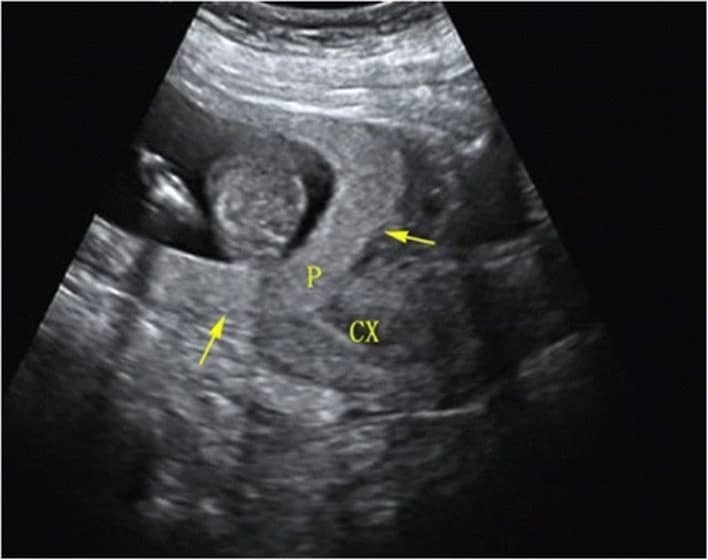 sonographic placenta previa