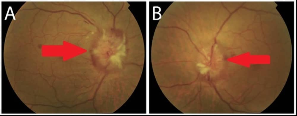bilateral papilledema in the optic disc