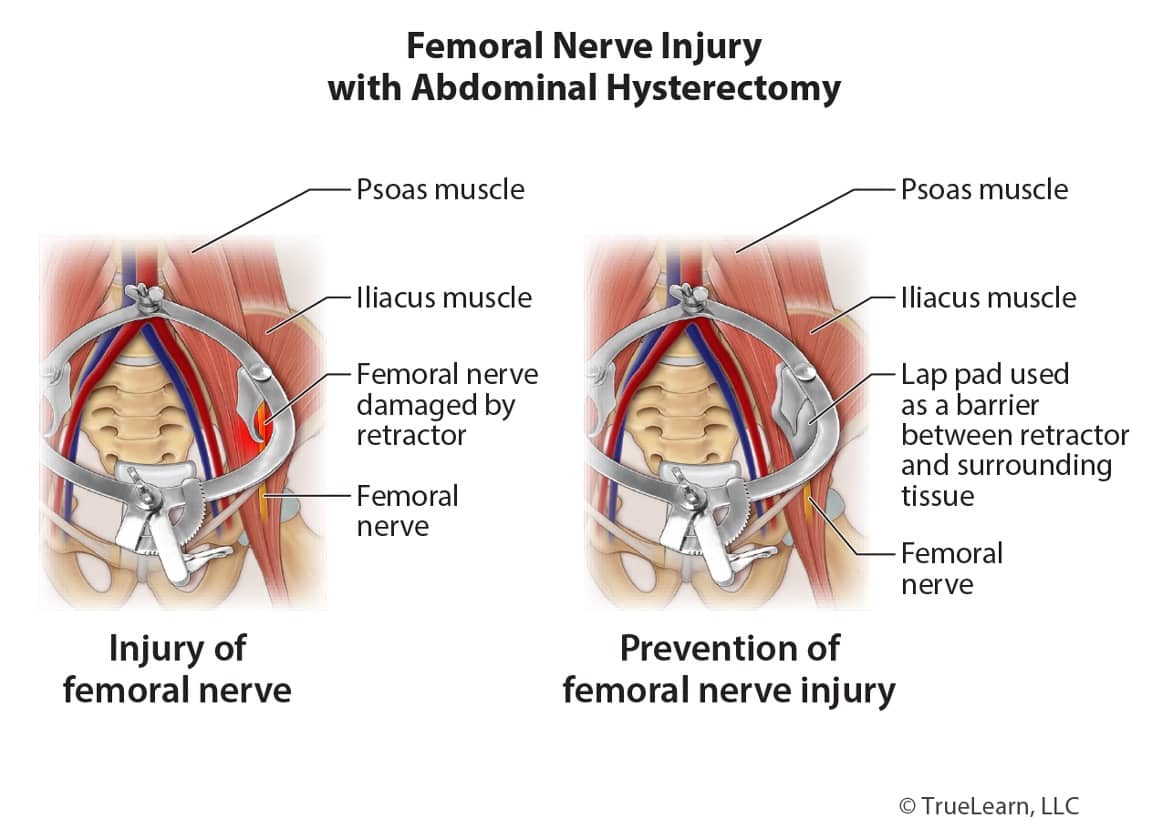 diagram of a femoral nerve injury with abdominal hysterectomy