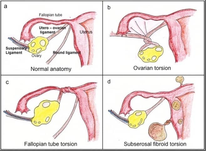 ovarian torsion anatomy diagrams
