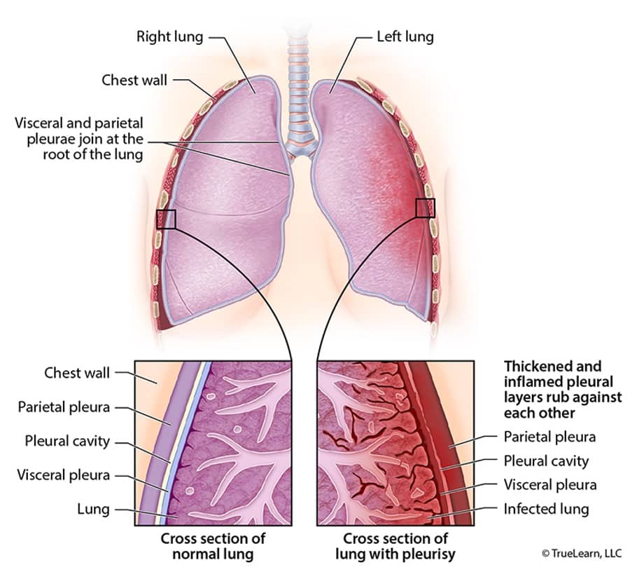 pleurisy vs normal lung diagram
