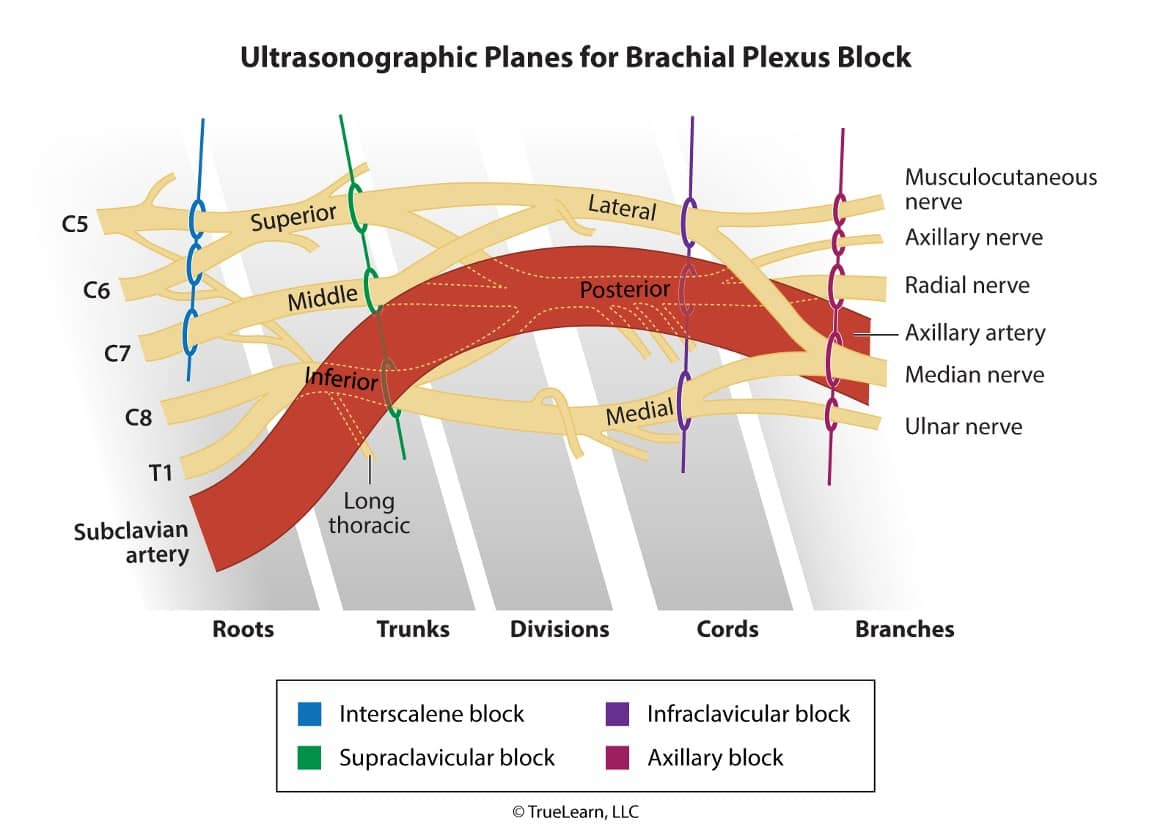 diagram of ultrasonographic planes for brachial plexus block