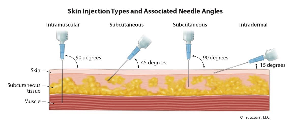 skin injection types and associated needle angles