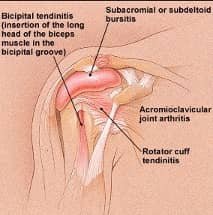 diagram of bicep tenodesis for a physician assistant sample question