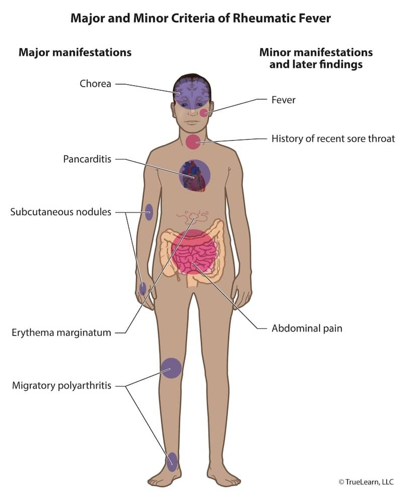 human body chart of major and minor criteria of rheumatic fever
