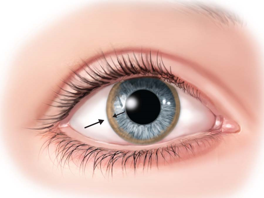 Eye with Copper Accumulation