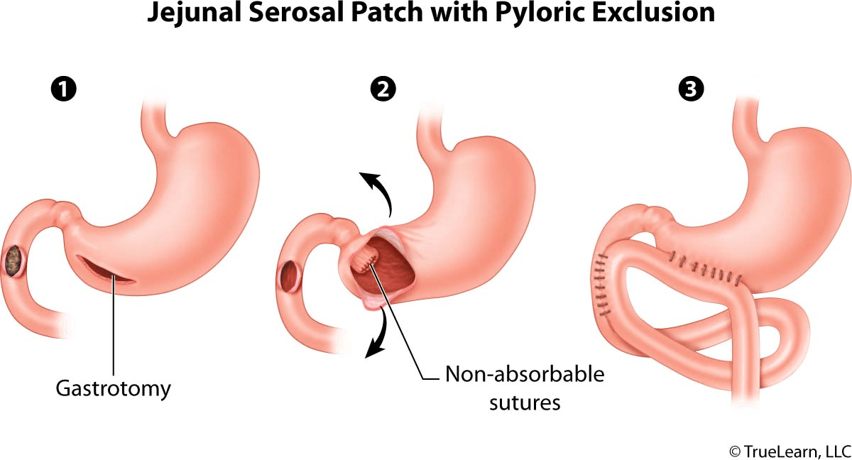 Three-step diagram of jejunal serosal patch with pyloric exclusion showing gastrotomy, pylorus closure with sutures, and jejunal patch placement.
