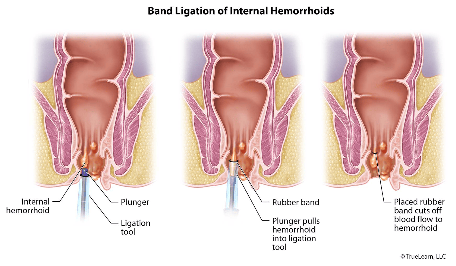 Three-step diagram showing rubber band ligation of an internal hemorrhoid using a ligation tool to cut off blood supply.