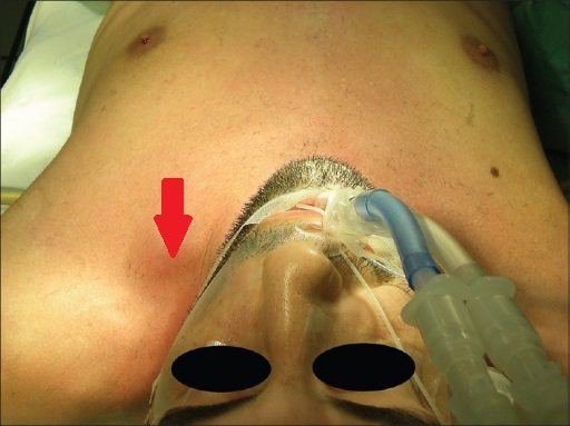 Thrombosed Internal Jugular Vein
