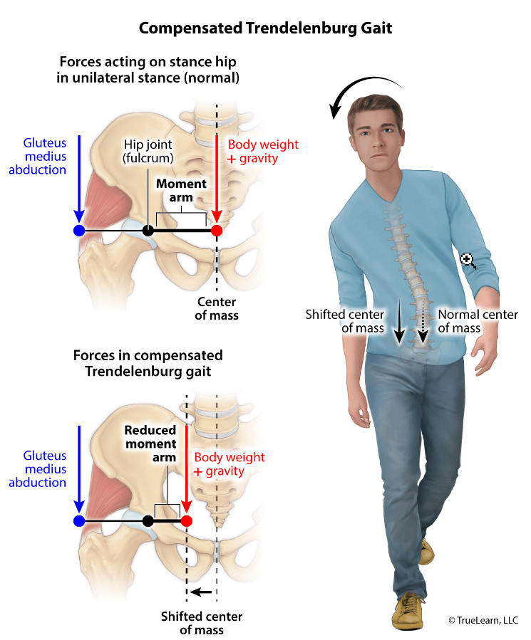 Compensated Trendelenburg Gait infographic