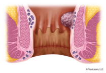 Vascular engorgement and bulging without prolapse