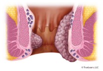 Hemorrhoids above and below the dentate line