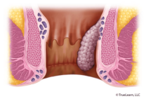 Prolapse reducible with manual pressure