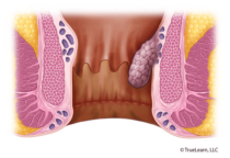 Prolapse with straining but reduces spontaneously