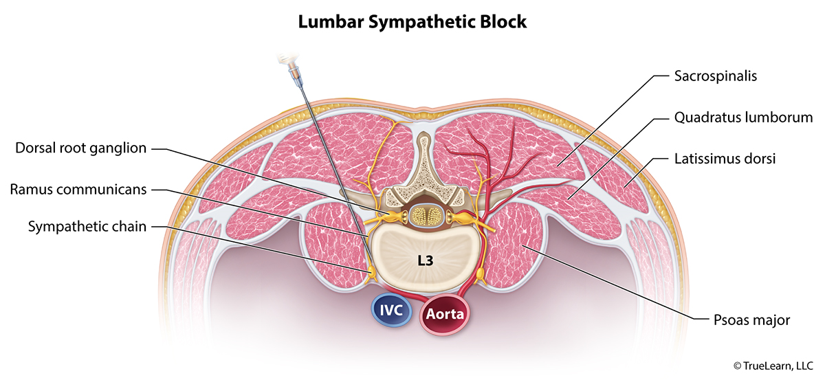 Lumbar Sympathetic Block Image