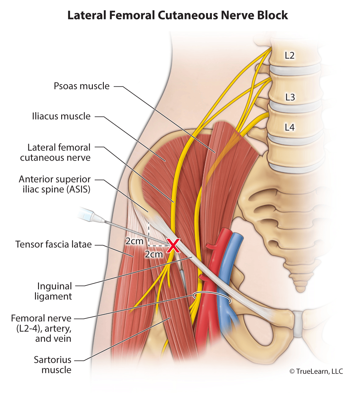 Illustration of a lateral femoral cutaneous nerve block showing anatomy and needle insertion point 2 cm medial and 2 cm inferior to the ASIS near the inguinal ligament.