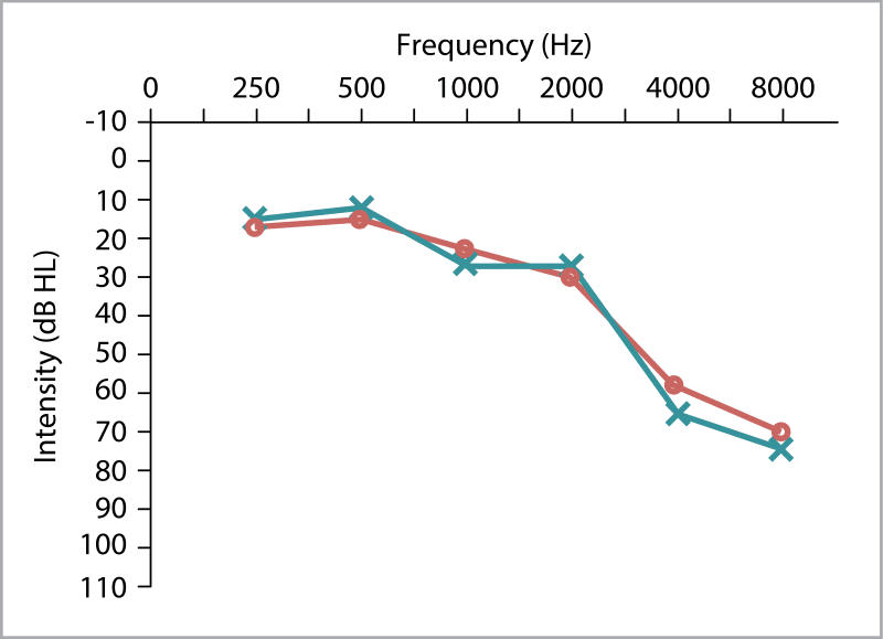 Audiogram showing bilateral sloping high-frequency hearing loss. Hearing is normal to mild at 250–500 Hz and declines to moderate–severe loss by 4000–8000 Hz, with similar thresholds in both ears.