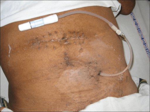 Postoperative photo after peritoneal dialysis catheter placement.
